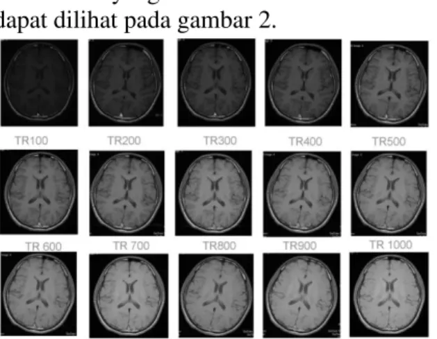 Gambar 2. MRI brain potongan axial sequence T1  SE 