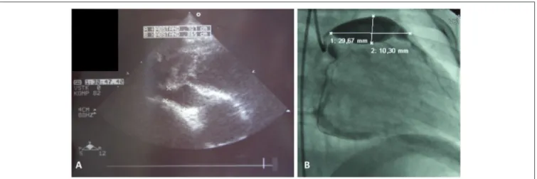 FIGURE 1 | Coronary artery aneurysms. (A) Cardial ultrasound of a 3 year old male showing right coronary vessel with aneurysm, and (B) classical coronary angiography in a 2 year old male unveiled giant aneurysm of the left coronay vessel.