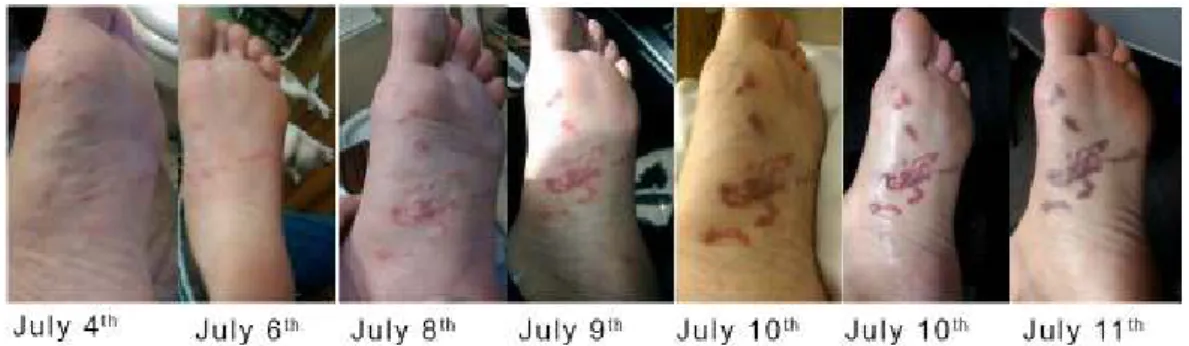 Gambar 2. Cutaneous Larva Migrans di Kaki Pasien Selama Satu Minggu 8 
