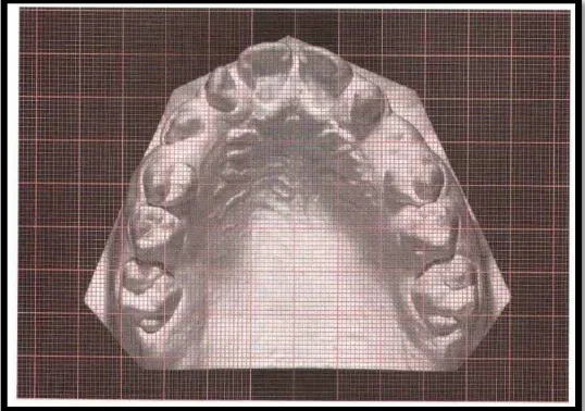 Gambar 2.1. Ruled grid transparan ditempatkan di atas  permukaan oklusal model studi untuk mengevaluasi asimetri lengkung gigi dan posisi gigi (diskrepansi sagital dan transversal)25 