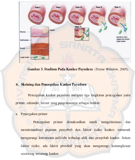 Gambar 3. Stadium Pada Kanker Payudara  (Terese Winslow, 2005). 