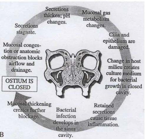 Gambar 4. Siklus rinosinusitis (Kennedy et al,1995) 