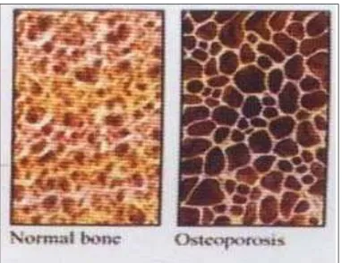 Gambar 2.1. Gambaran tulang pada orang normal dan osteoporosis  