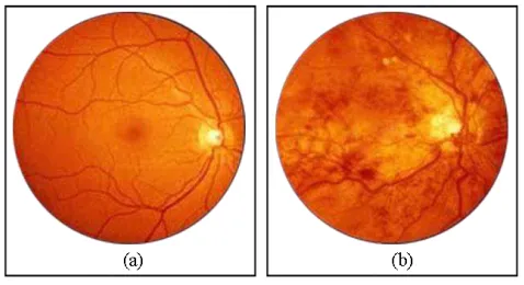 Gambar 2. 1: Retina mata (a) normal, (b)  Diabetic Retinopathy 