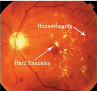 Gambar 2. 2: Kelainan pada retina berupa hard exudate