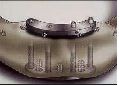 Gambar 4. Implan transoseous. (Anonymous. Transosseous implants. <medical-dictionary. thefreedictionary.com> (20 Nov 2011) 