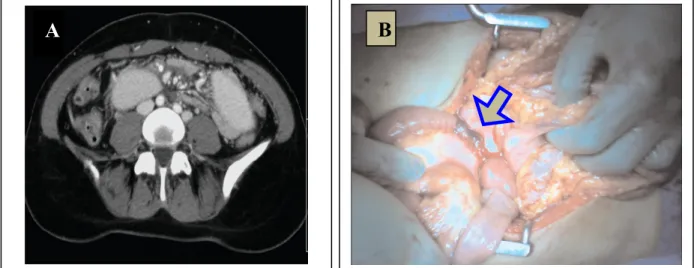 Gambar 2. A. CT scan abdomen menunjukkan obstruksi usus halus bagian proksimal. B. foto intraoperative  memperlihatkan adanya massa yang menyumbat di sebelah retroperitoneal