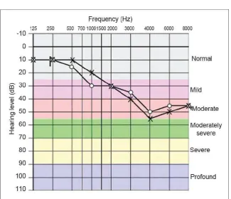 Gambar 2.5  Audiogram tuli akibat bising (vinodh, 2010)  