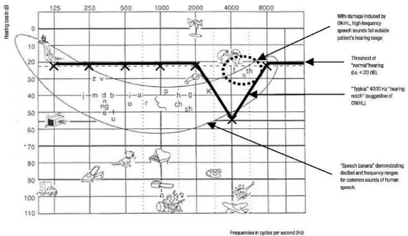 Gambar 2.2 Gambaran audiogram dengan ‘speech banana’gambaran khas gangguan pendengaran akibat bising takik pada 4.000 Hz  mendekati (Kurmis, 2007) 