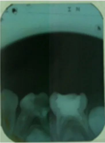 Gambar 1. Gambaran radiograf saat pasien datang.  Pada  regio 74 terdapat radiolusensi pada mahkota gigi bagian  oklusal dan distal mencapai pulpa, terdapat radiolusensi  pada daerah periradikular dan sekitar furkasi, resorpsi  akar mencapai sepertiga apik