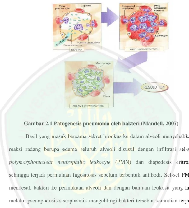 Gambar 2.1 Patogenesis pneumonia oleh bakteri (Mandell, 2007)  Basil yang masuk bersama sekret bronkus ke dalam alveoli menyebabkan reaksi  radang  berupa  edema  seluruh  alveoli  disusul  dengan  infiltrasi  sel-sel polymorphonuclear  neutrophilic  leuko