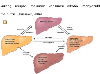 Gambar 3 Penyakit Liver Alkoholik (Theise, 2015)