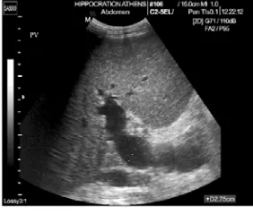 Gambar 2.7 Contoh USG yang menunjukkan dilatasi vena porta (2.75cm)pada pasien dengan hipertensi portal (dikutip dari Cokkinos D 2009)  