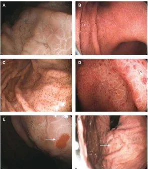 Gambar 2.9 Gambaran endoskopi  yang menunjukkan karakteristik utama GHP 