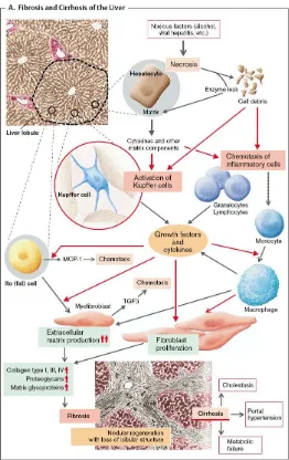 Gambar 2.2 Patogenesis fibrosis dan sirosis hati (Silbernagl S 2000) 