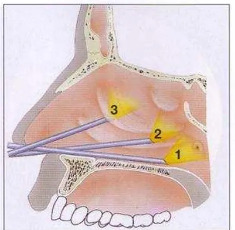 Gambar 2.9. Gambaran skematis pemeriksaan endoskopik  (Stammberger, 2004) 