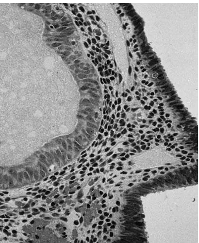 Gambar 4. Atypical simple hyperplasia. Epitel dengan kelenjar atipik ( kiri ) hiperplasia dengan 