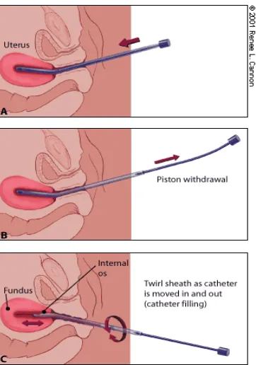 Gambar 5. Kateter suction endometrial. Saat kateter berada dalam kavum uteri, piston ditarik keluar