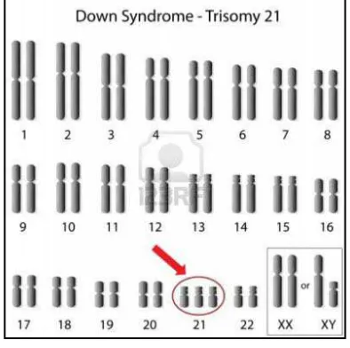 Gambar 1. Kromosom pada Sindrom 