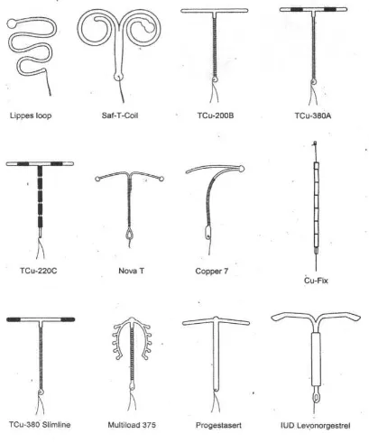 Gambar 2.1. Jenis-Jenis IUD 