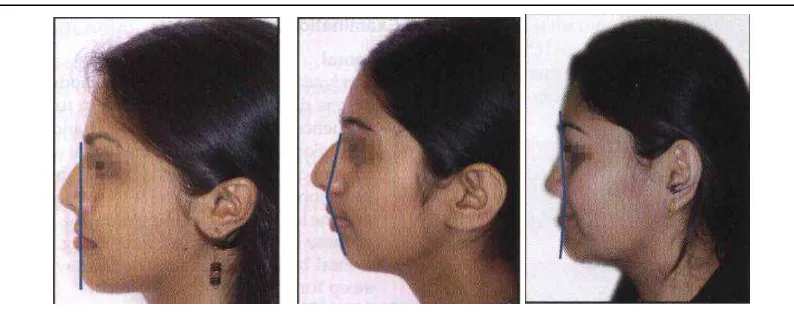 Gambar 5. Profil wajah menurut Schwarz (1987): a. Average face (lurus) b.   Anteface (cembung) c