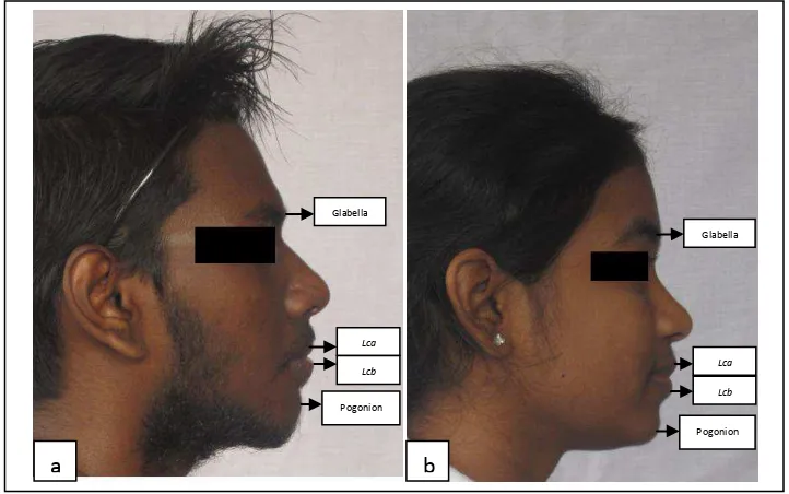 Gambar 8.  Titik – titik acuan pada foto profil wajah mahasiswa India Tamil Malaysia FKG USU: a