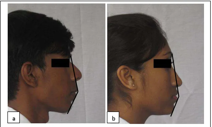 Gambar 9. Hasil pengukuran foto profil wajah mahasiswa India Tamil   Malaysia dengan oklusi normal FKG USU: a