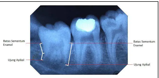 Gambar 7. Cara pengukuran panjang akar molar tiga mandibula 