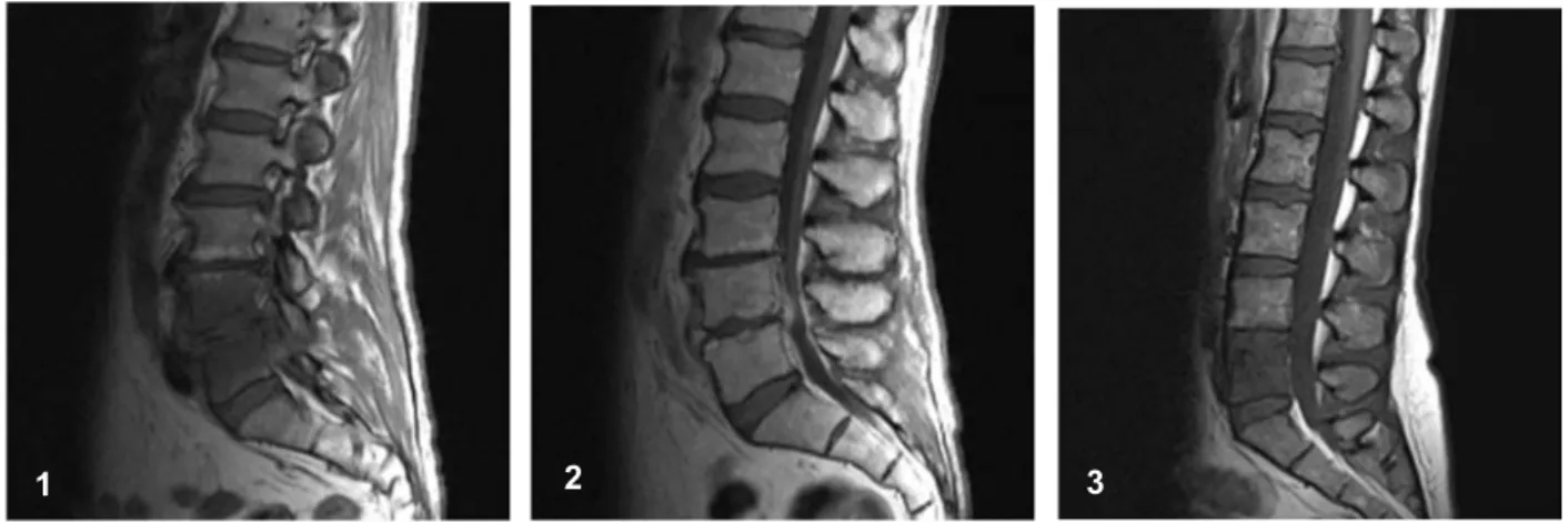 Fig. 1. Sagittal T1WI shows dif- dif-fuse edema of L4 and L5  verte-bral bodies, decreased disc height,  and hypointensity of prevertebral  and  epidural  fat  due  to   inflam-mation.