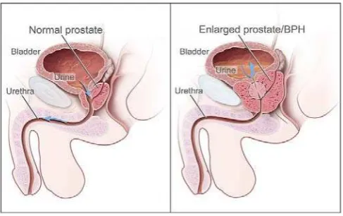 Gambar 2.3  Gambaran Prostat Normal Dibandingkan dengan BPH 