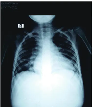 FIGURE 3. Vegetation inside the lumen of main pulmonary artery and RVOT. AO: aorta; MPA: main pulmonary artery; RVOT: right ventricular outflow tract
