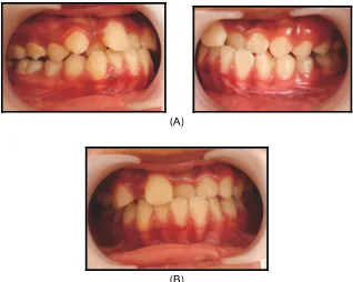 Gambar 1.Pemeriksaan ekstra oral menunjukkan tipe muka normal (A) dengan pro l cembung (B) bibir dan lip seal positif (C)