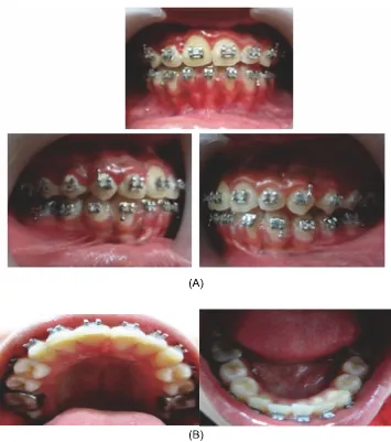Gambar 6. Gambaran setelah perawatan ortodontik cekat selama 6 bulan, terlihat susunan gigi telah rapi (A) Pandangan labial, kiri dan kanan (B) Gambaran Rahang Atas dan Rahang Bawah