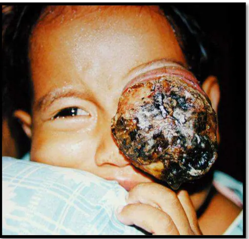 Gambar 4. Perluasan Ekstraokular Tumor (emedicine.medscape.com) 