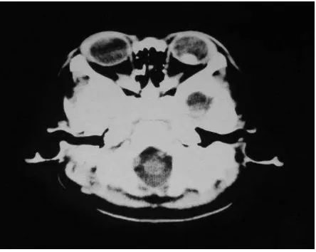 Gambar 6. Tampilan CT-Scan Retinoblastoma Ekstraokular 