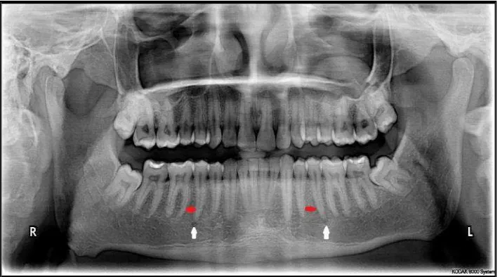 Gambar 5. Radiograf panoramik posisi  foramen mentalis. 3 Posisi foramen mentalis (tanda panah putih) segaris dengan premolar kedua (tanda panah merah)