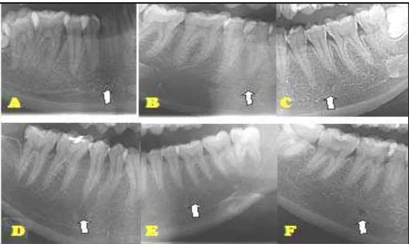 Gambar 7. Gambaran  radiografi panoramik posisi foramen mentalis pada mahasiswa suku Batak di FKG USU