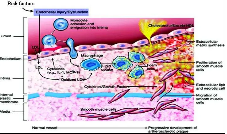 Gambar 3.  Patogenesis aterosklerosis dikutip dari:  Packard RRS, Libby P. Inflammation in atherosclerosis: from vascular biology to biomarker discovery 