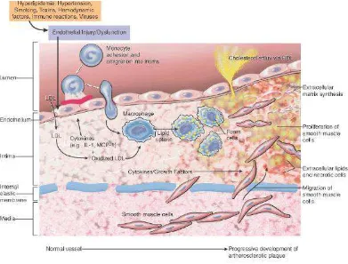 Gambar 2.2 : Proses Pembentukan Aterosklerosis 
