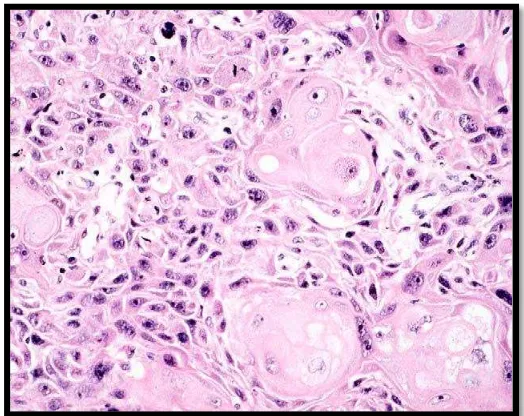 Gambar 2.2 Karsinoma sel skuamosa, keratinizing Pulau-pulau sel-sel 