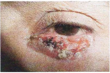 Gambar 2.7. Karsinoma sel basal noduloulseratif berpigmen pada kelopak mata kanan bagian    bawah.35  