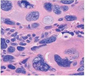 Gambar 2.10. Karsinoma sel basal nodular dengan sel raksasa.5 