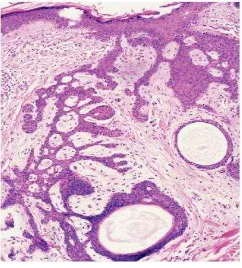 Gambar 2.14. Karsinoma sel basal dengan differensiasi adneksa; hamartoma folikuler basaloid.5  