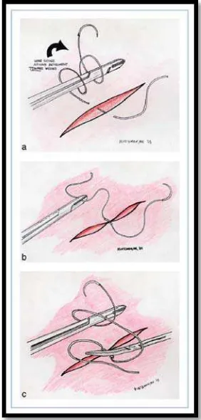 Gambar 11. Surgeon’s knot14