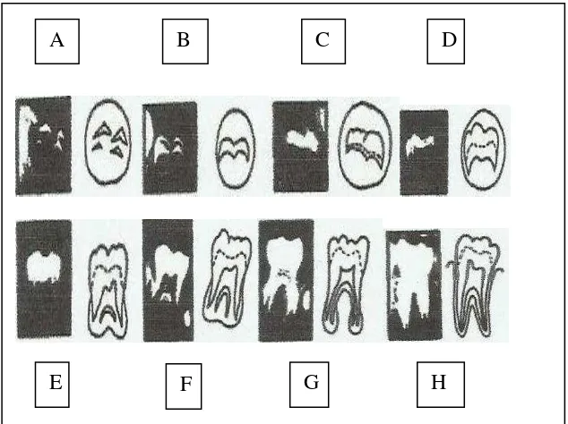 Gambar 7. Tahap perkembangan akar gigi molar mandibula6,13 