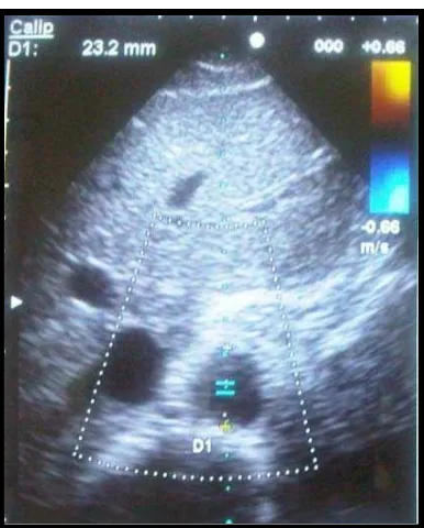 Gambar 2.1. Pengukuran diameter aorta abdominalis 