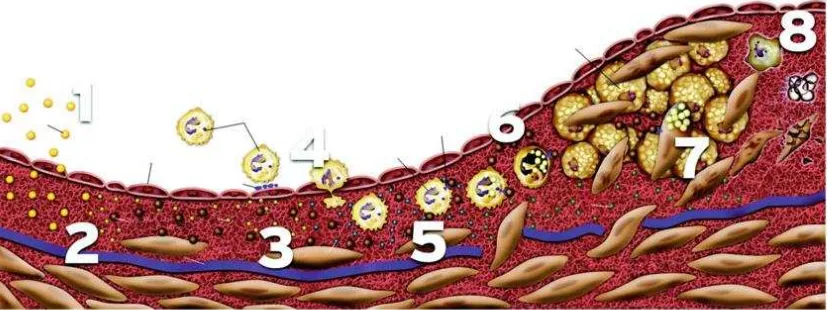 Gambar 2.1. Tahapan Perkembangan Plak aterosklerosis. (1) LDL diambil oleh endotel (2) OKsidasi LDL oleh makrofag dan