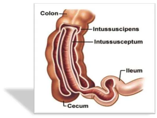 Gambar 1. Intususepsi usus halus yang masuk ke usus besar (Mckee, jawetz 1996) 