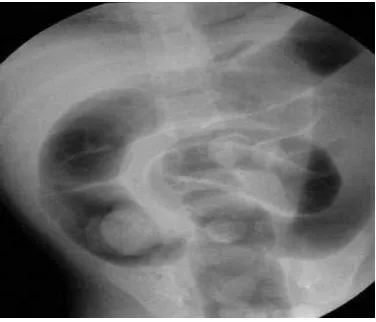 Gambar 9. Barium enema menunjukkan intussusepsi di colon desenden (Gabriel, 2011) 