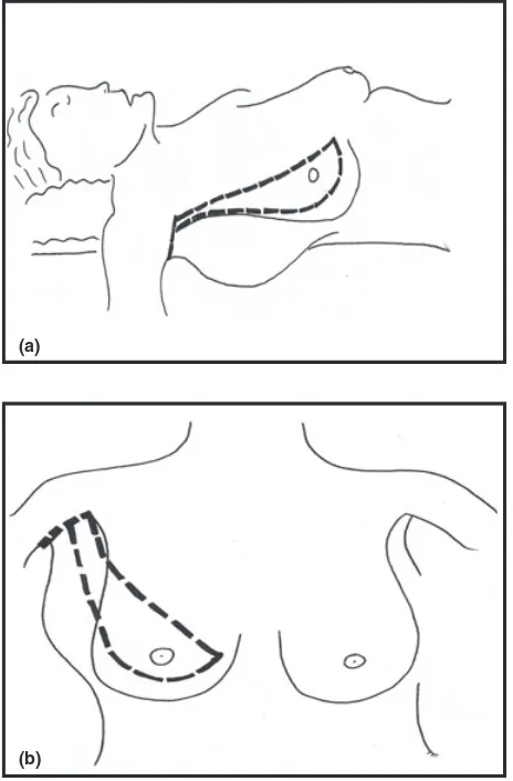 Figure 3. Detail of proximal incisions in relation to the muscles.
